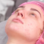 HORMONAL ACNE: TRADITIONAL TREATMENTS AND NATURAL REMEDIES